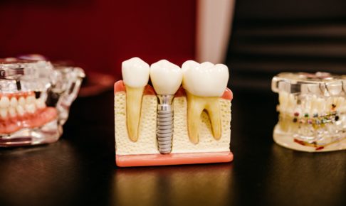 歯列矯正以外にも歯科治療全般に対応いています　つくば市の歯医者　つるみ矯正歯科